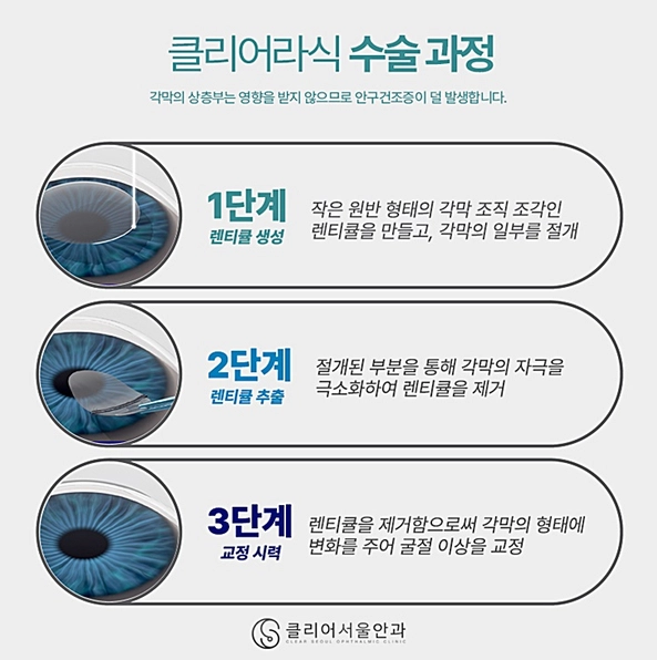강남역 클리어서울안과의 스마일라식 기법인 클리어라식 수술 과정을 설명한 단계 이미지