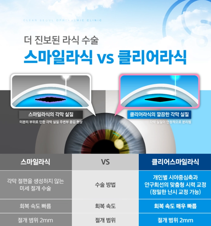 스마일라식 검사 전 각막의 모습