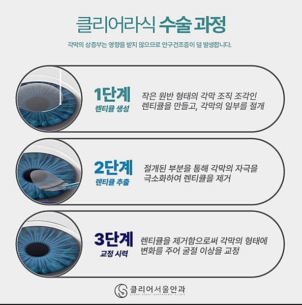 클리어서울안과만의 클리어라식 수술 과정 설명