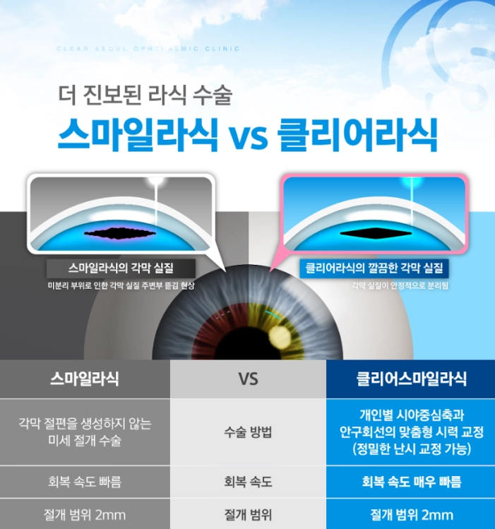 스마일라식 렌티큘 추출 원리 도식
